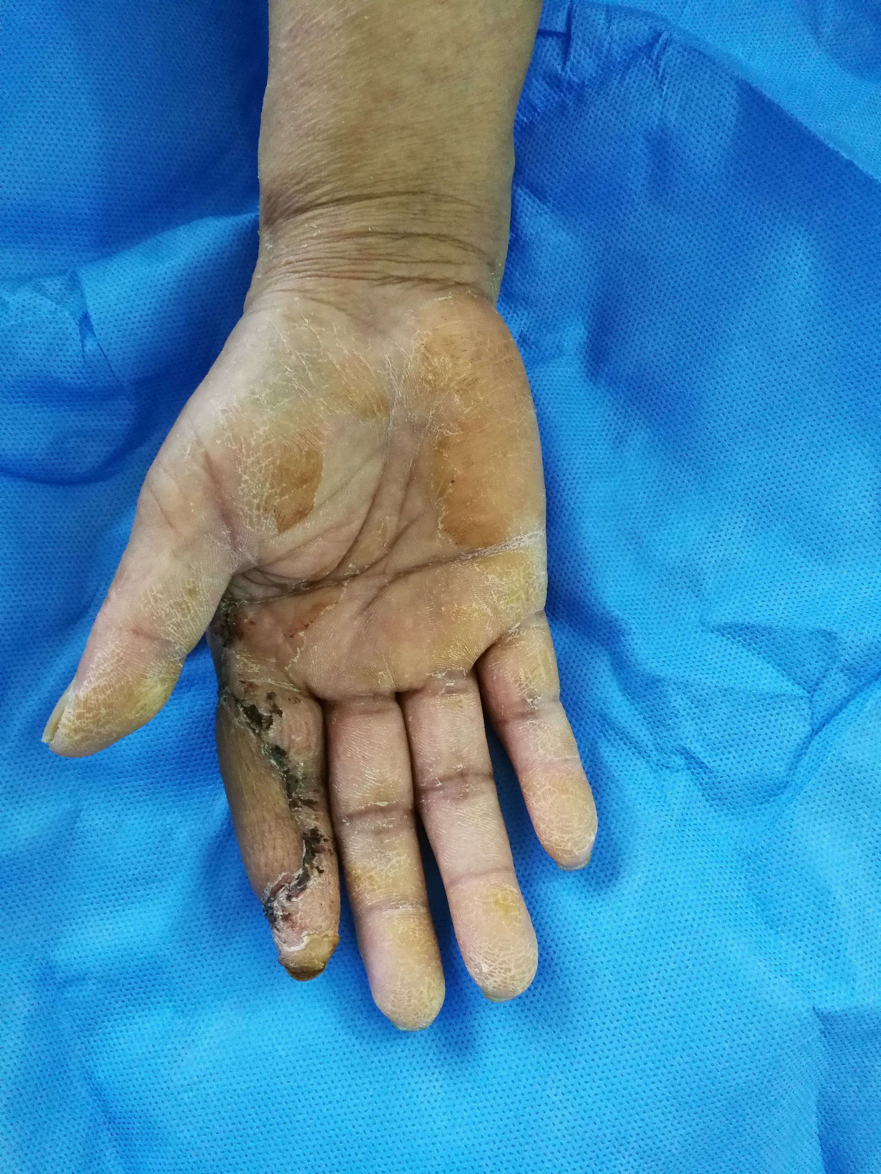 骨间背动脉穿支皮瓣修复手指皮肤软组织缺损的治疗. - 好大夫在线