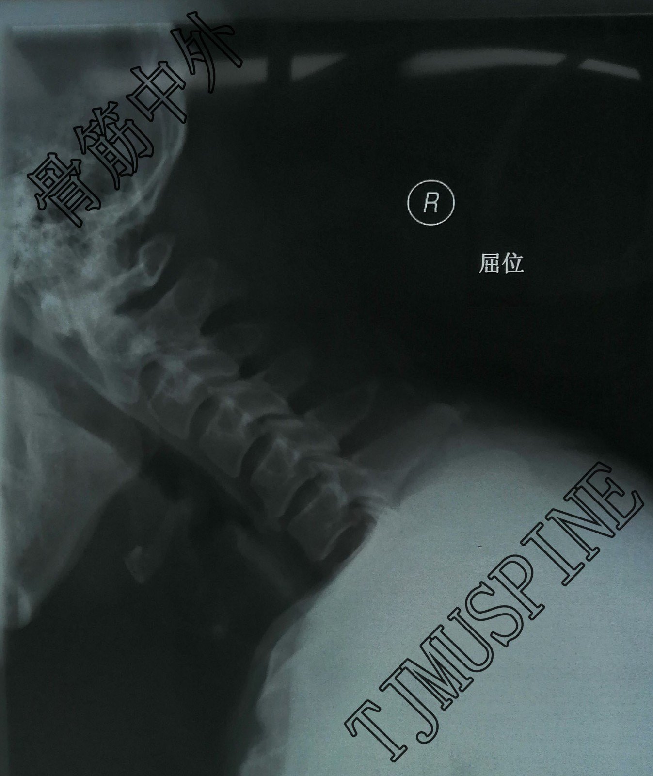 屈伸动力位术前x线正侧位