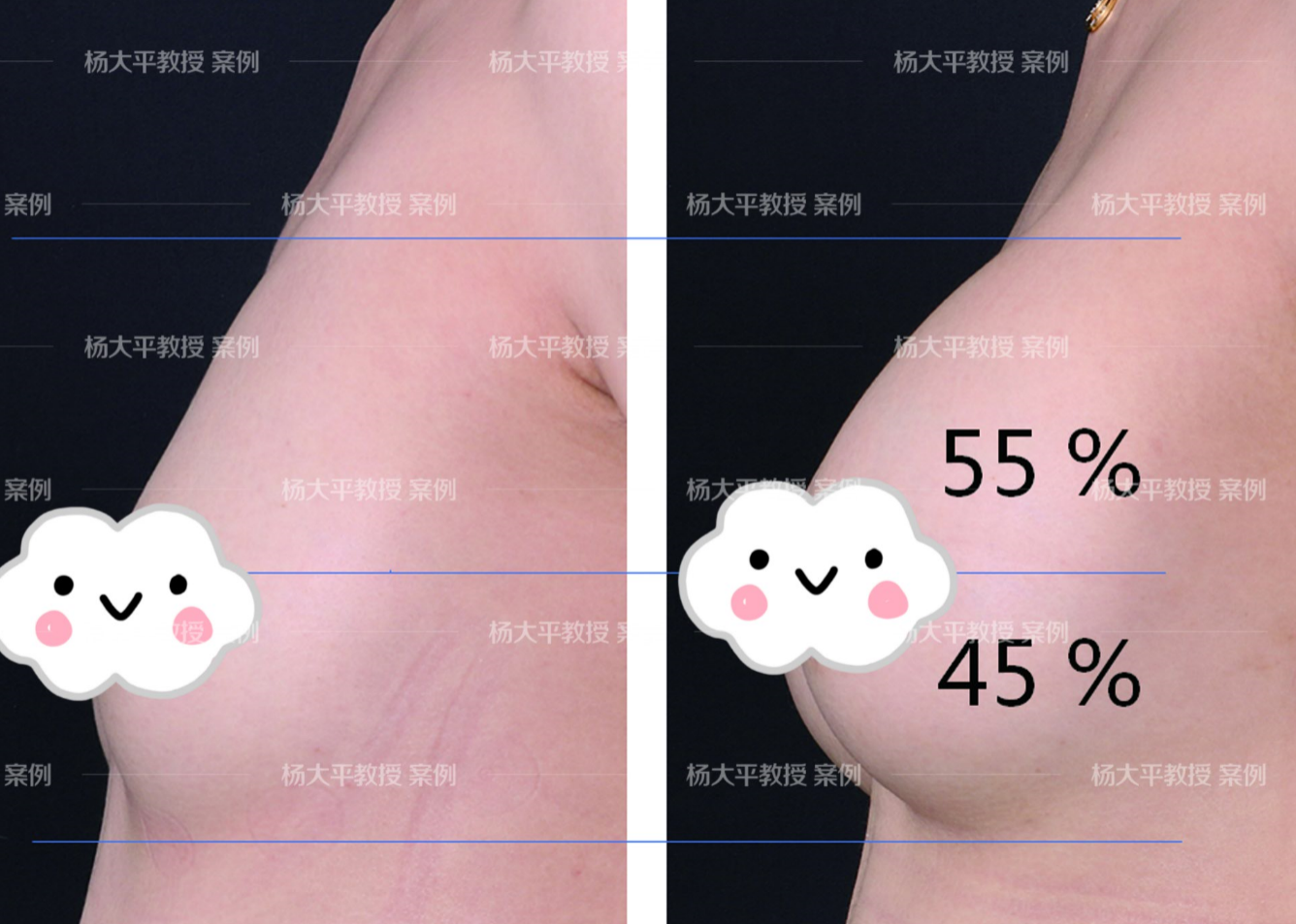 什么是水滴胸 y4YBAFzfcKiAJKfnABDhsGHr6cs975.png?_ms_=a1a0