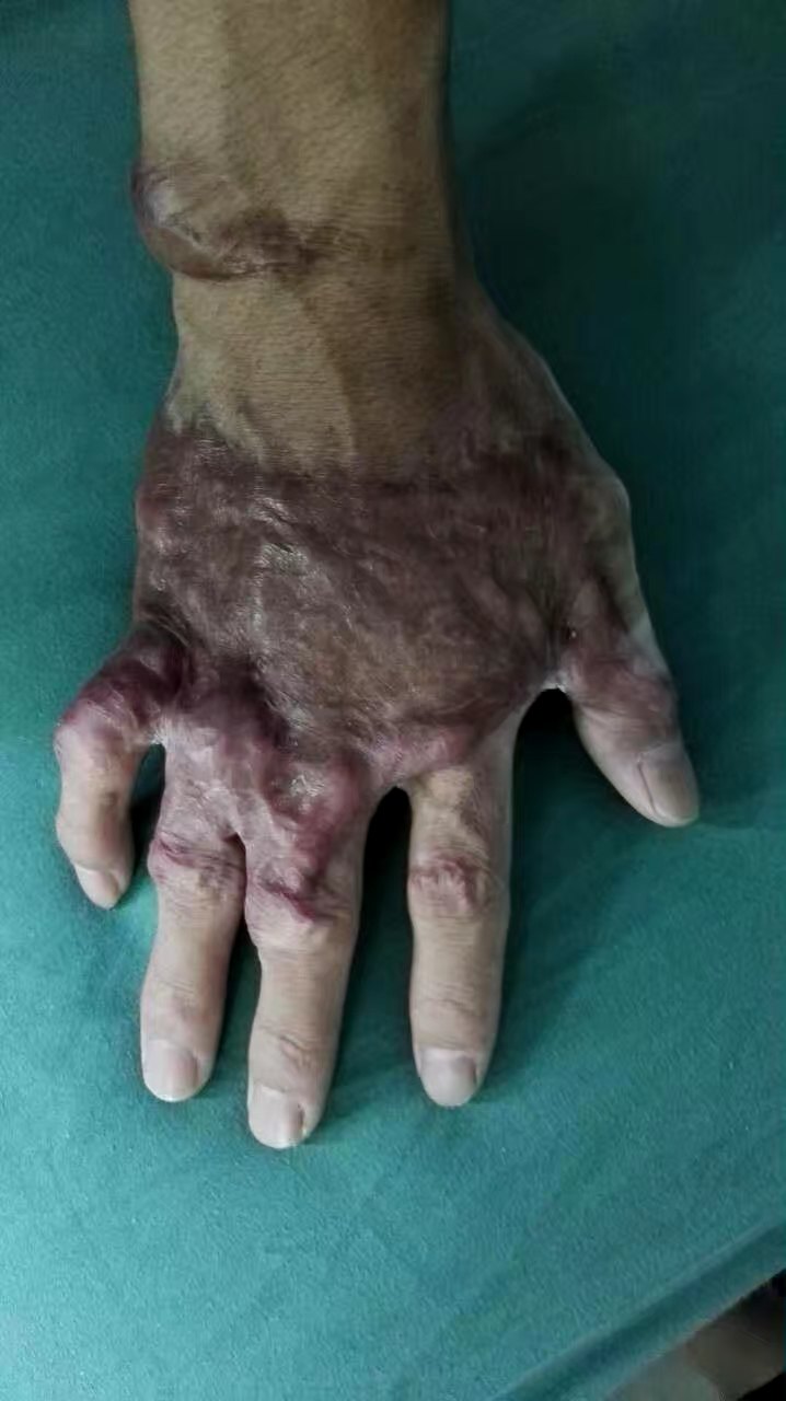 手背疤痕(瘢痕)增生挛缩畸形整形手术前后对比 