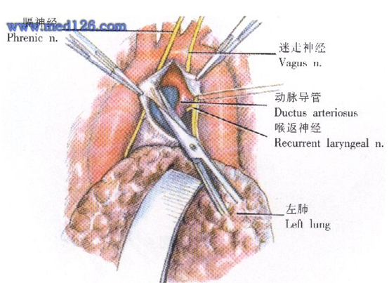 此方法畸形矯正確實,可避免術後導管再通或結紮線穿透管壁而發生動脈