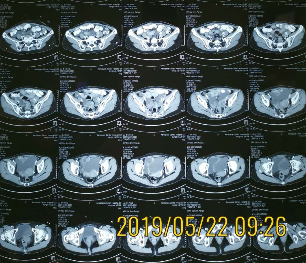 5 手术目的及预设方案:从ct病灶分布,着重清除右髂窝及盆腔积液,子宫