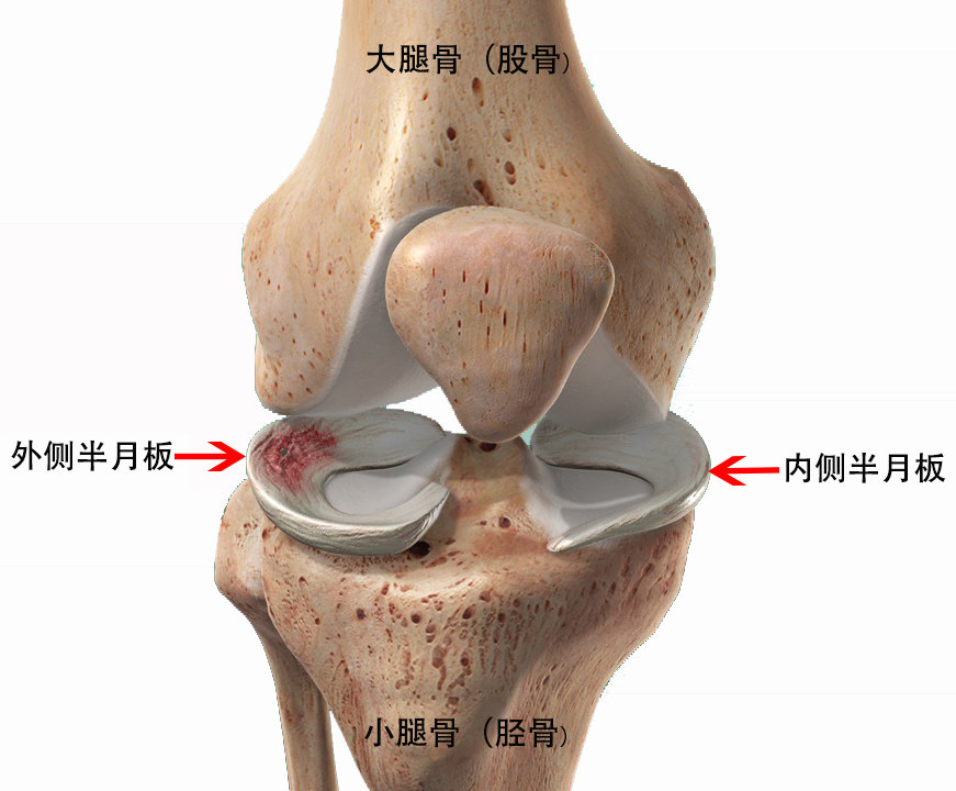 半月板是膝关节内的月牙形软骨结构,位于大腿骨(股骨)和小腿骨(胫骨)