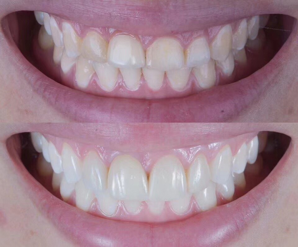 牙齿过短,形态不好看怎么办? - 好大夫在线