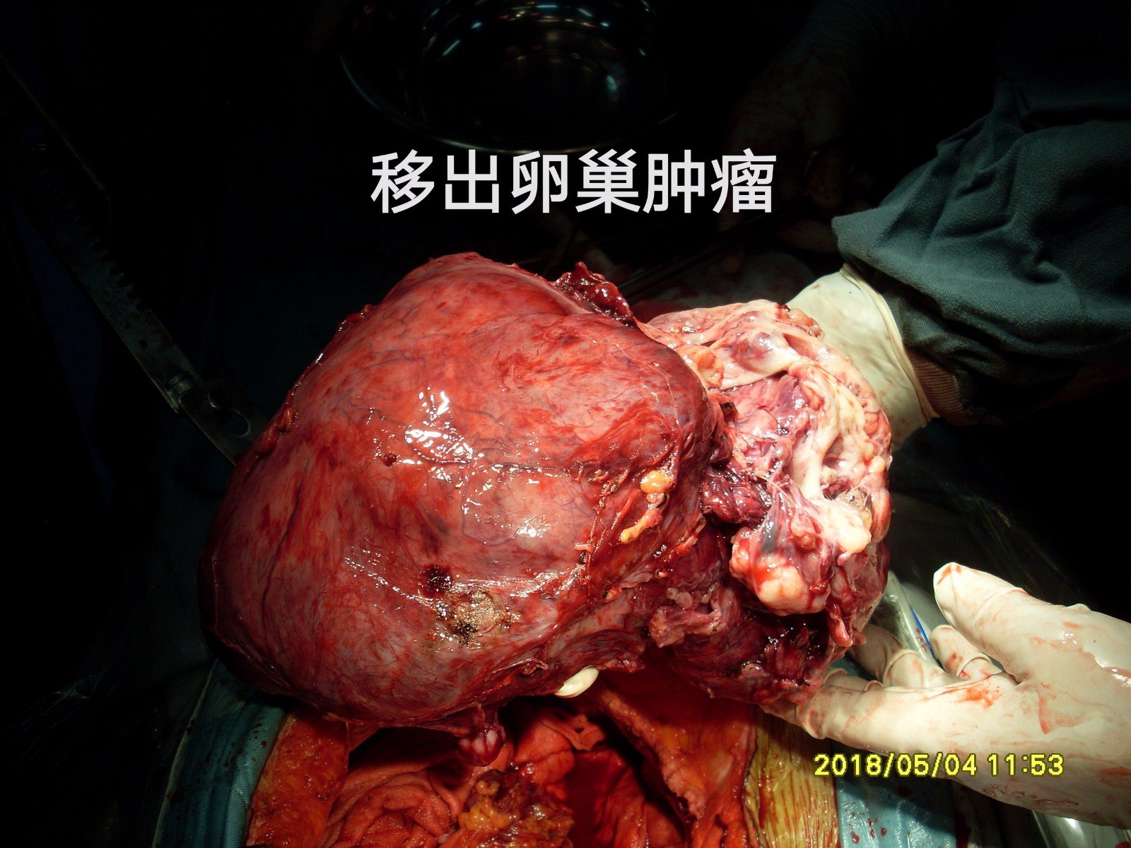 病例100直肠腺癌也可以直接浸润累及卵巢形成卵巢巨大肿物