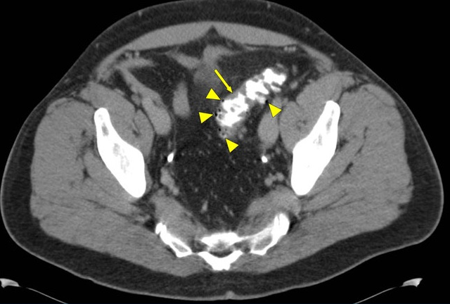 腹痛常见疾病及急性结肠憩室炎介绍_腹痛_治疗方法_病因_相关疾病