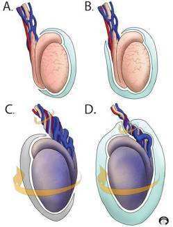 睾丸扭转的早期,用徒手复位即能获得良效.