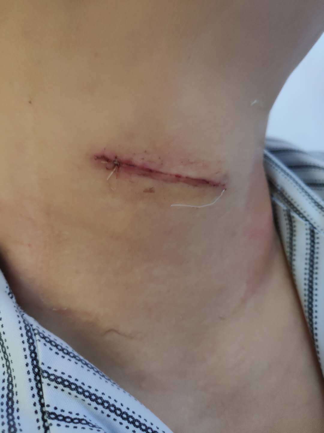 扁桃体手术伤口恢复图图片