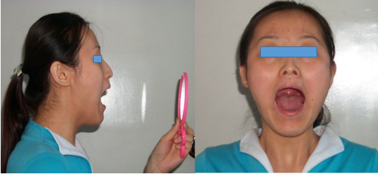 这一动作掌握好后,则不需要牙签指示也能作正常张口,每小时锻炼一次