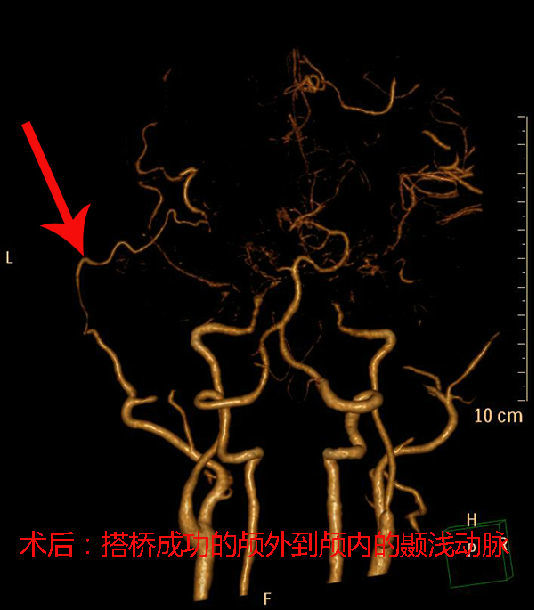 左側額顳開顱顳淺動脈大腦中動脈搭橋