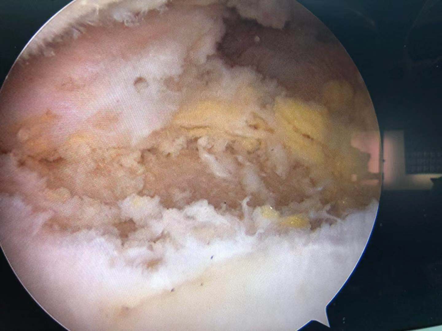 滑膜软骨瘤图片图片