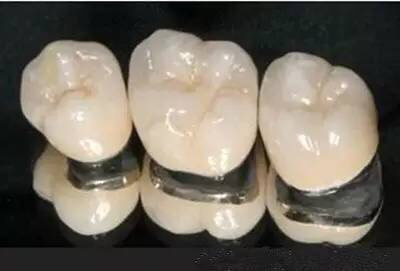 根管治疗后,别忘给牙齿戴上安全帽