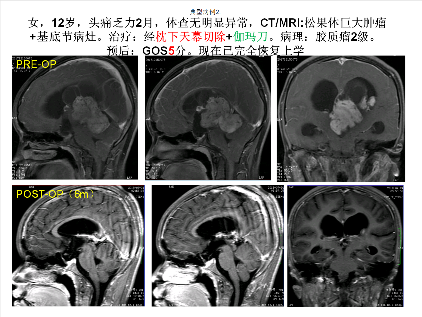 松果体区肿瘤诊疗