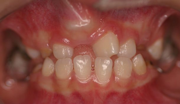 牙齒部分萌出或完全不能萌出 兒童前牙多見.