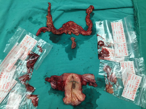 卵巢癌2013年12月您给做的手术～三医院梅主任给