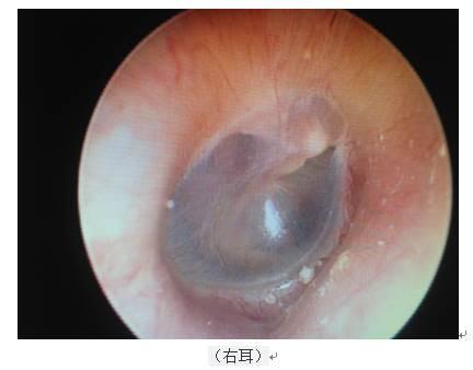 左耳鼓膜图片