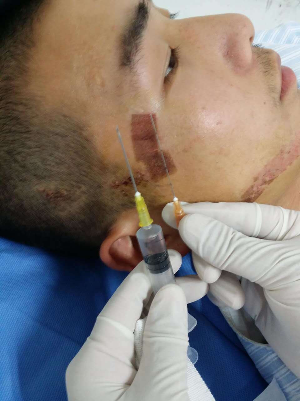 图解注射美容栓塞并发症的预防 - 好大夫在线