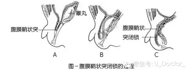 宝宝精索鞘膜积液图片