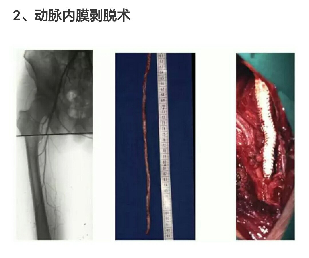 4,腔內技術開通動脈血流腹主--髂或股動脈,腋--股動脈,雙側股動脈(股