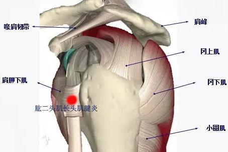 較常見,由於反覆活動導致肱二頭肌長頭肌腱磨損導致炎性改變,主要表現
