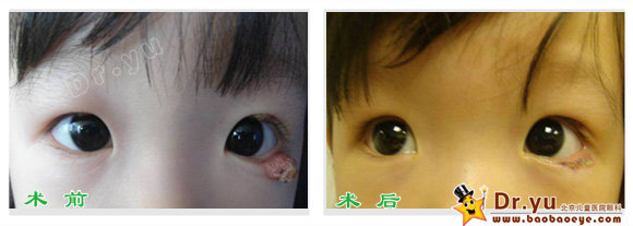 霰粒肿手术前后照片 强脉冲新疗法非手术治疗霰粒肿 霰粒肿 饮食运动 症状 治疗方法