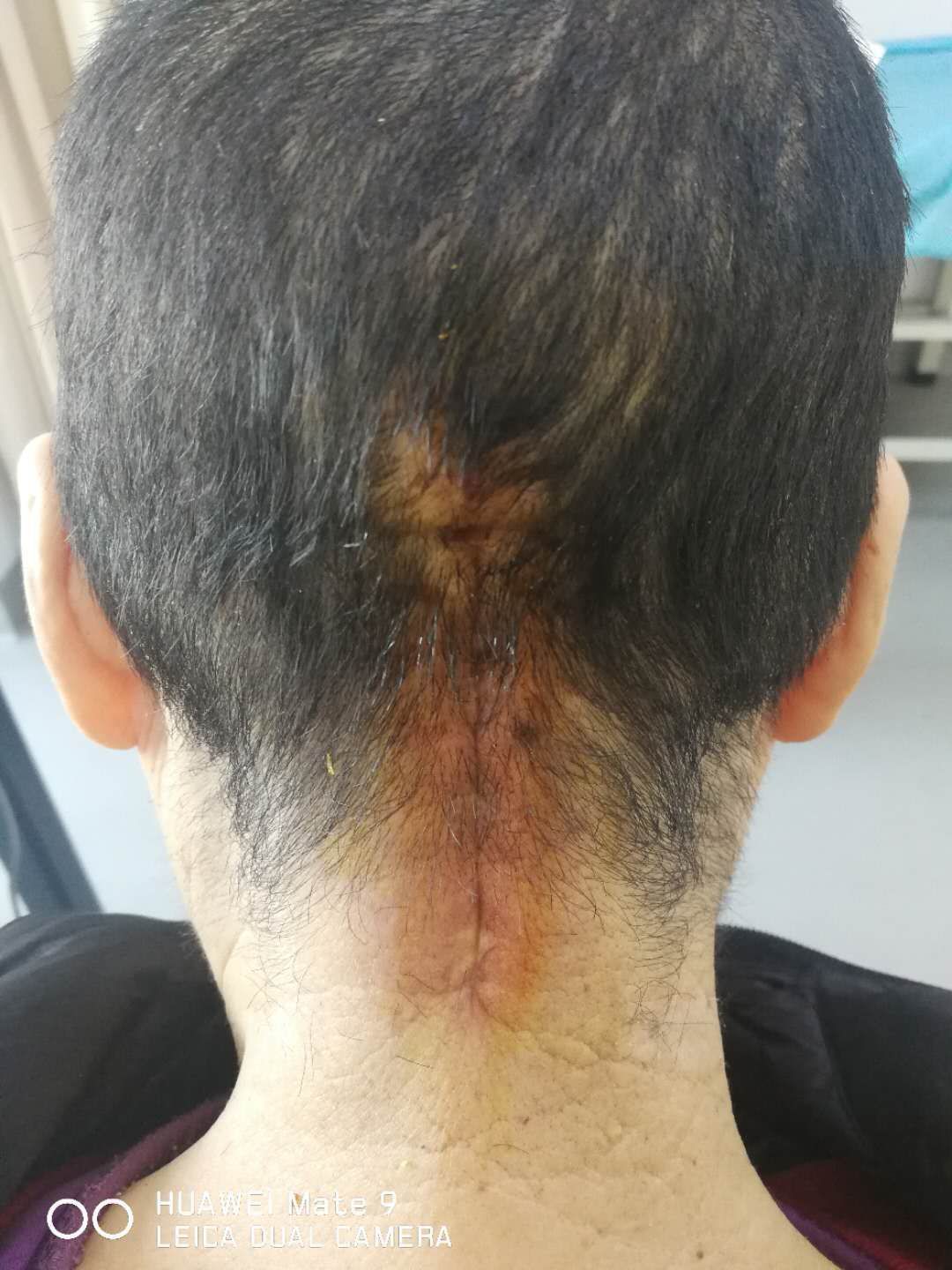 小脑扁桃体下疝畸形 之手术治疗