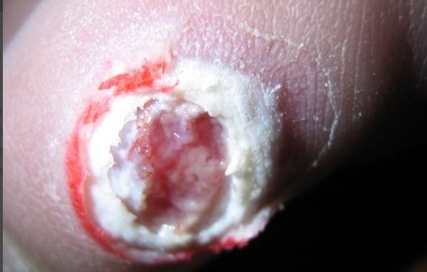 图解跖疣鸡眼和胼胝三者区别