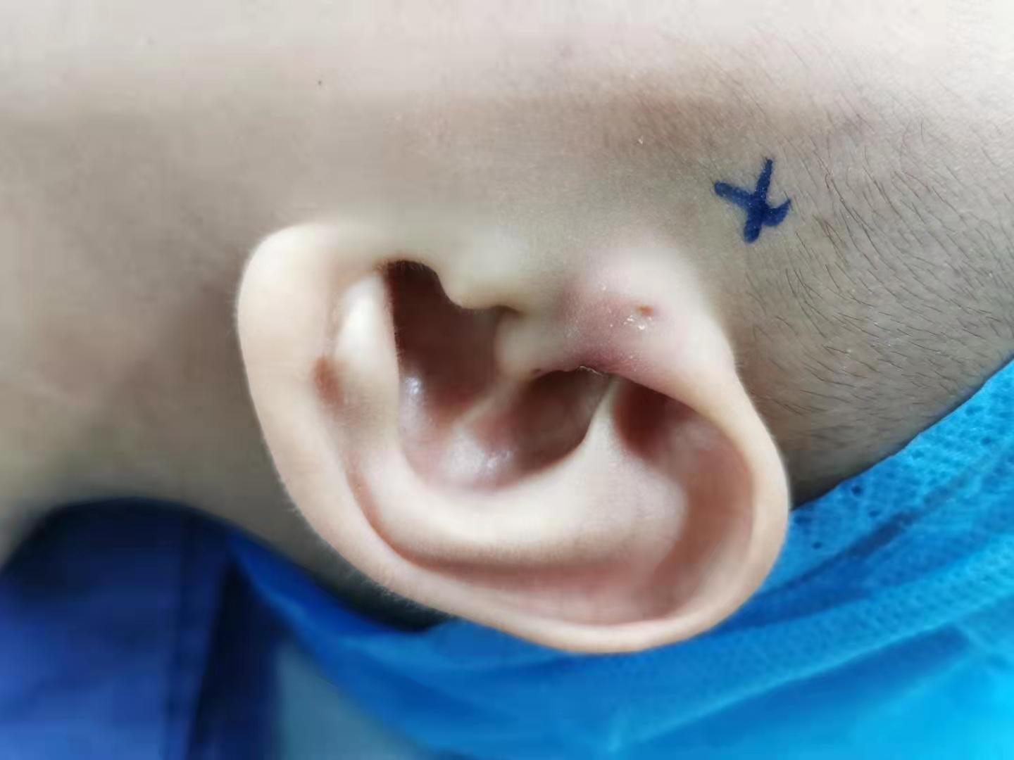 先天性耳前瘘管，发炎后需手术治疗_先天性耳前瘘管 - 好大夫在线
