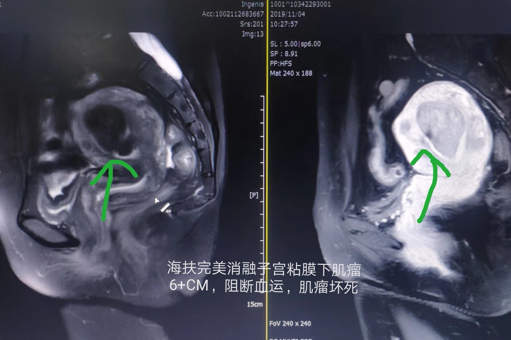 海扶 宮腔鏡,微無創聯合,完美治療子宮粘膜下大肌瘤 - 好大夫在線