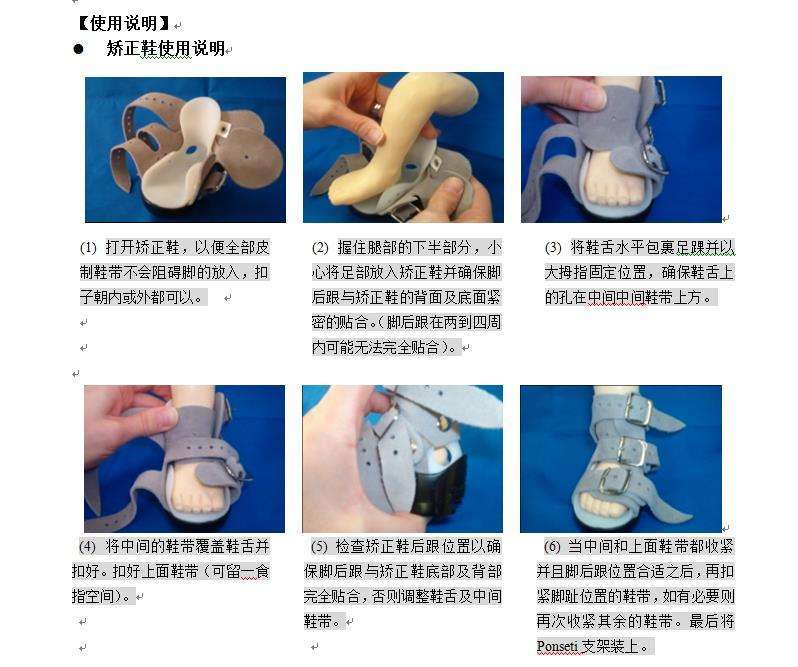 先天性马蹄内翻足_治疗方式_康复锻炼 - 好大夫在线