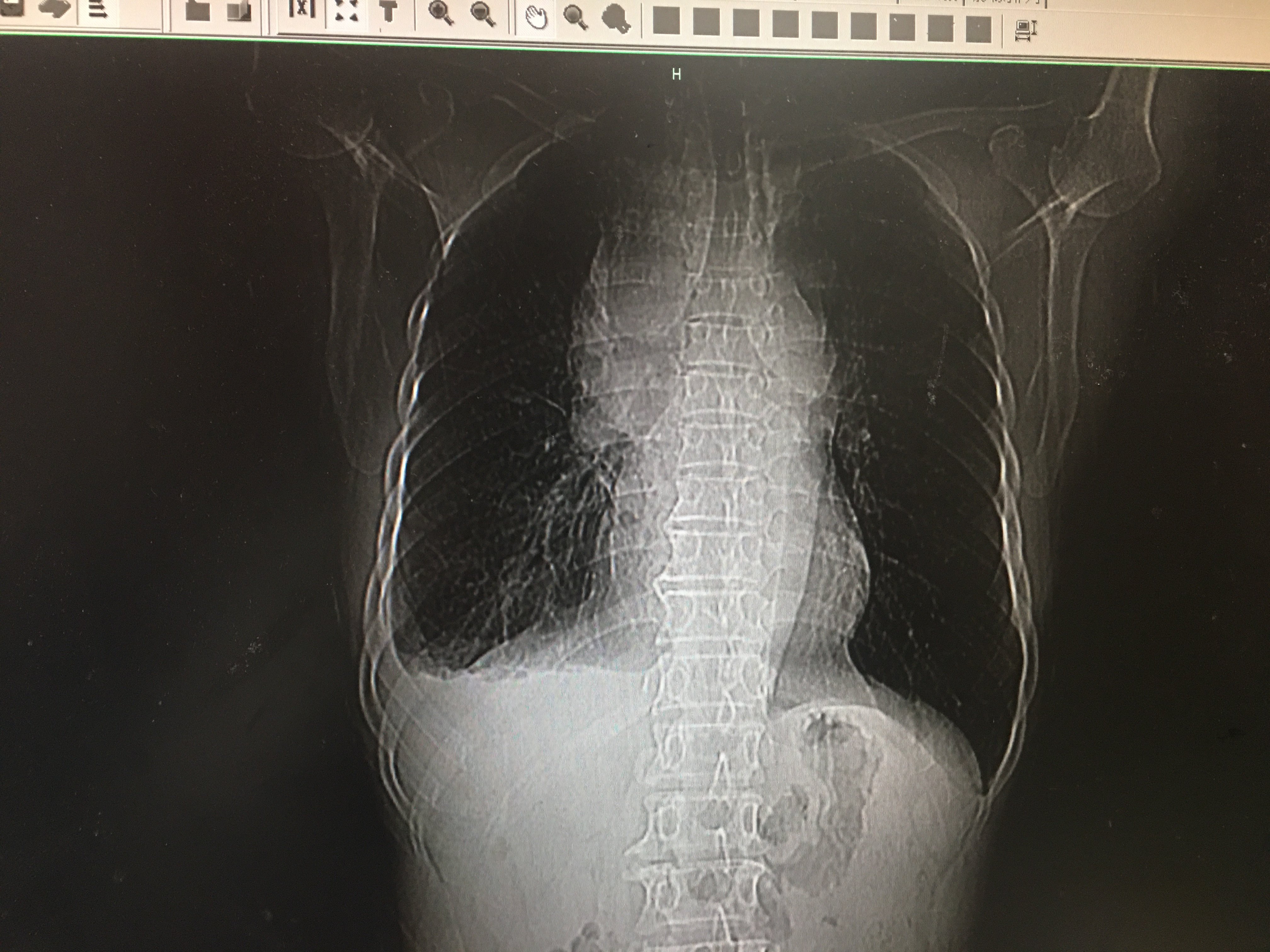 最大直径11厘米,周围血管受压显著,以上腔静脉显著,增强ct检查提示前