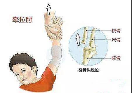 小心宝宝肘关节为什么易脱臼 肘关节脱臼的表现 该如何治疗 肘关节脱位 小心宝宝肘关节为什么易脱臼 肘关节脱臼的表现 该如何治疗 肘关节脱位