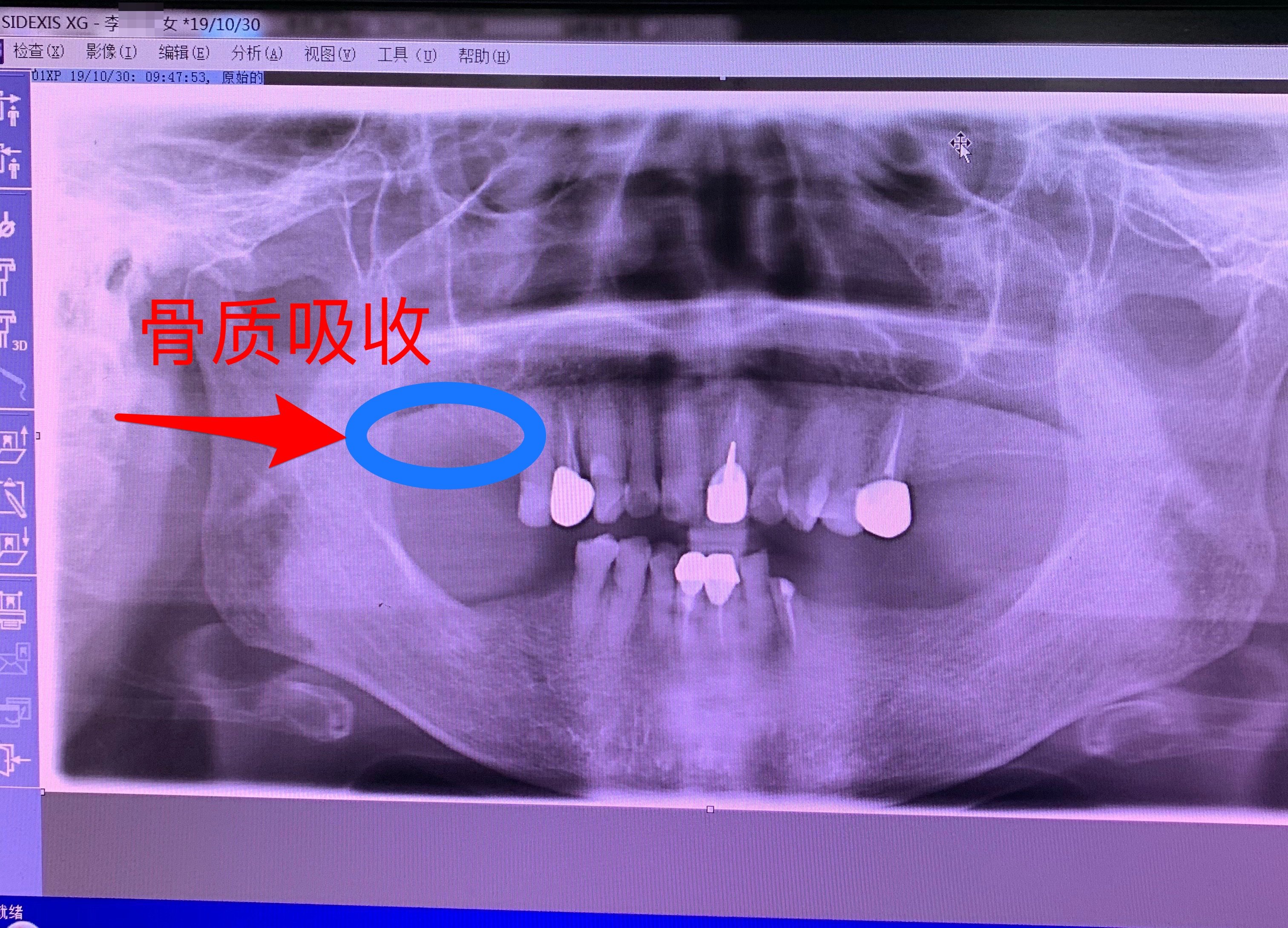 牙骨质瘤影像图片图片