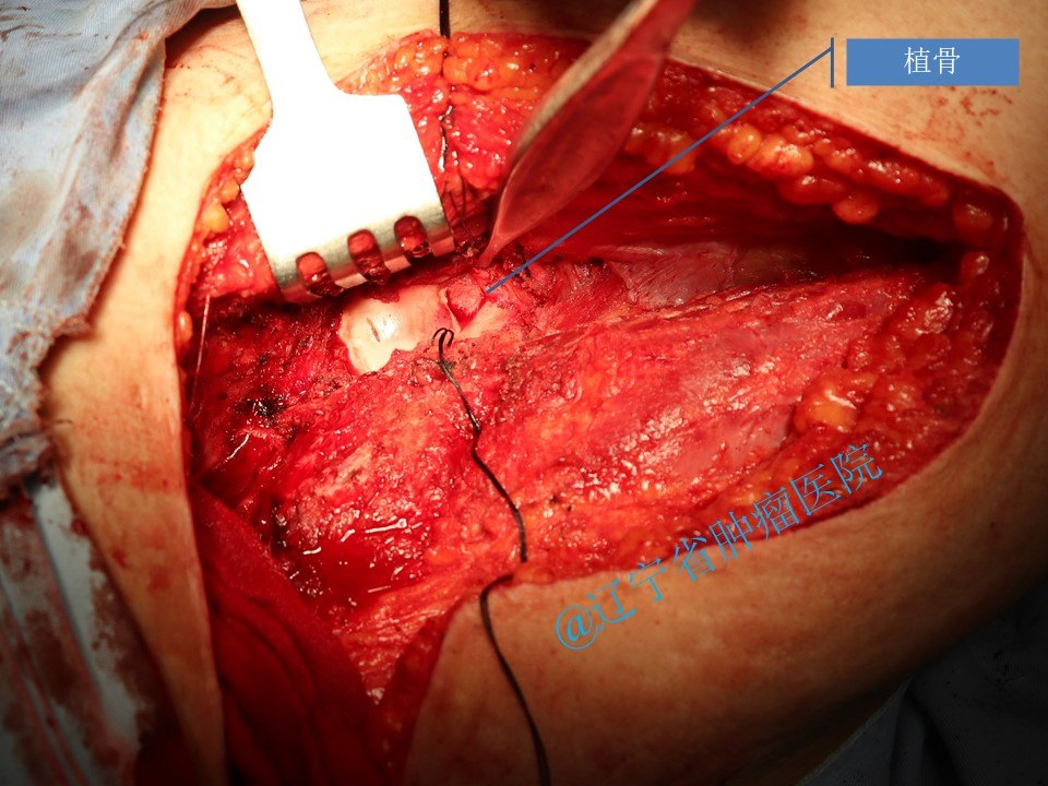 股骨头颈部单纯性骨囊肿手术 - 好大夫在线
