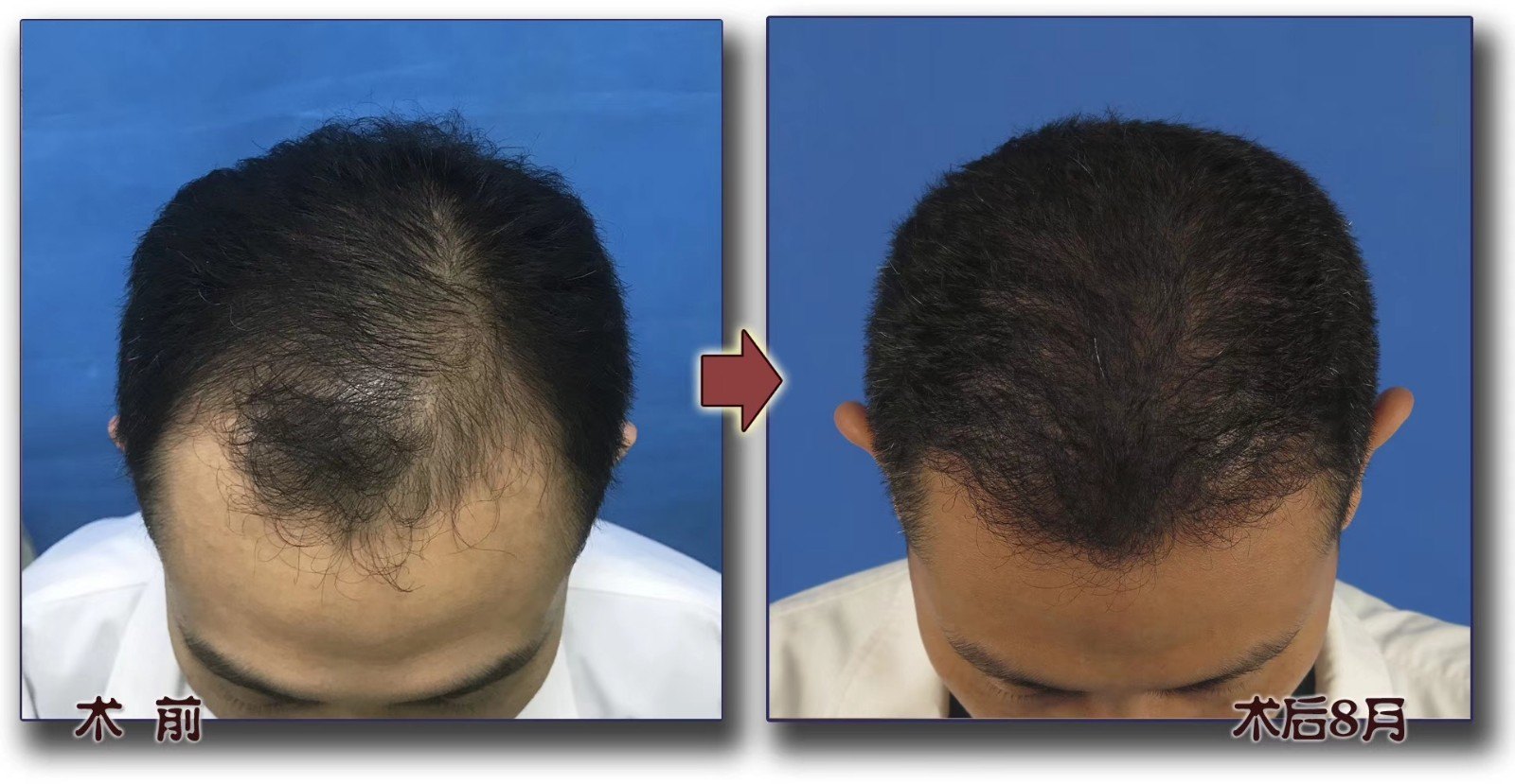 男性雄激素性秃发的毛发移植(附15个案例照片)
