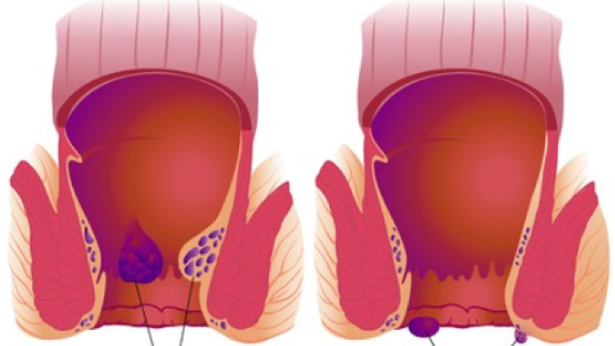 肛門長了個肉疙瘩是怎麼回事?