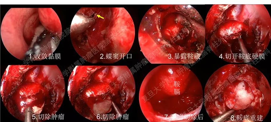 神經內鏡技術神經內鏡下經蝶竇垂體瘤切除術