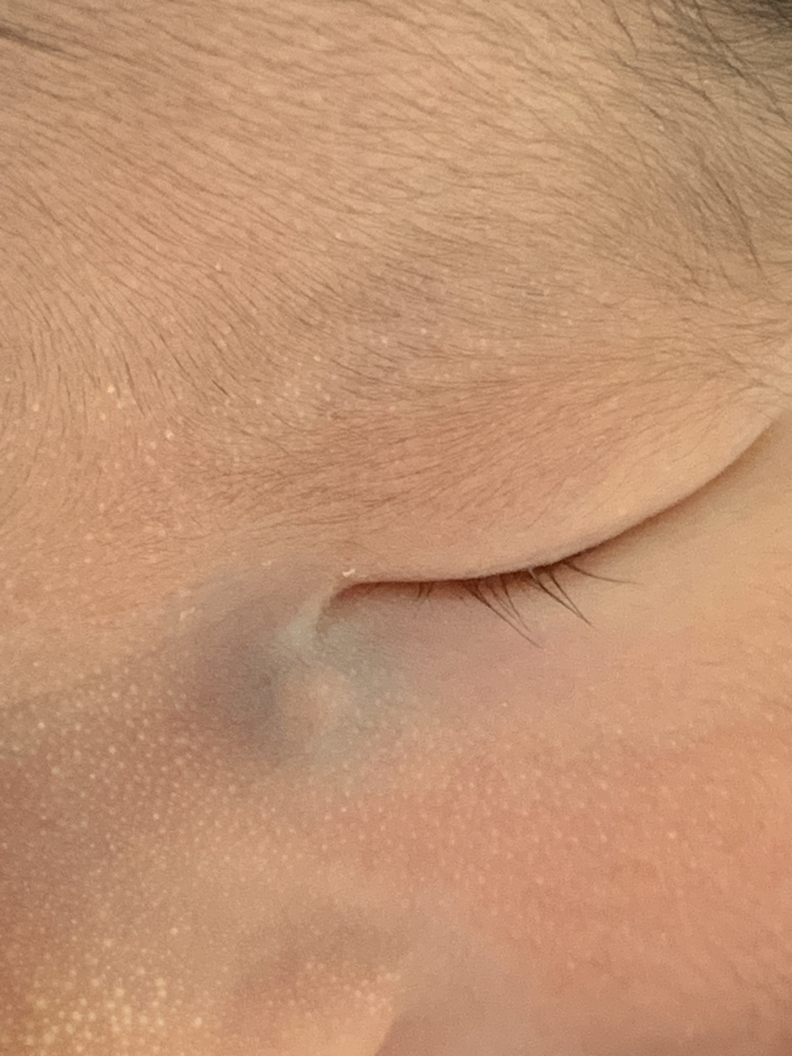 出生后内眦部暗紫色囊肿轻按后局部皮肤受刺激发红积液从泪小点溢出