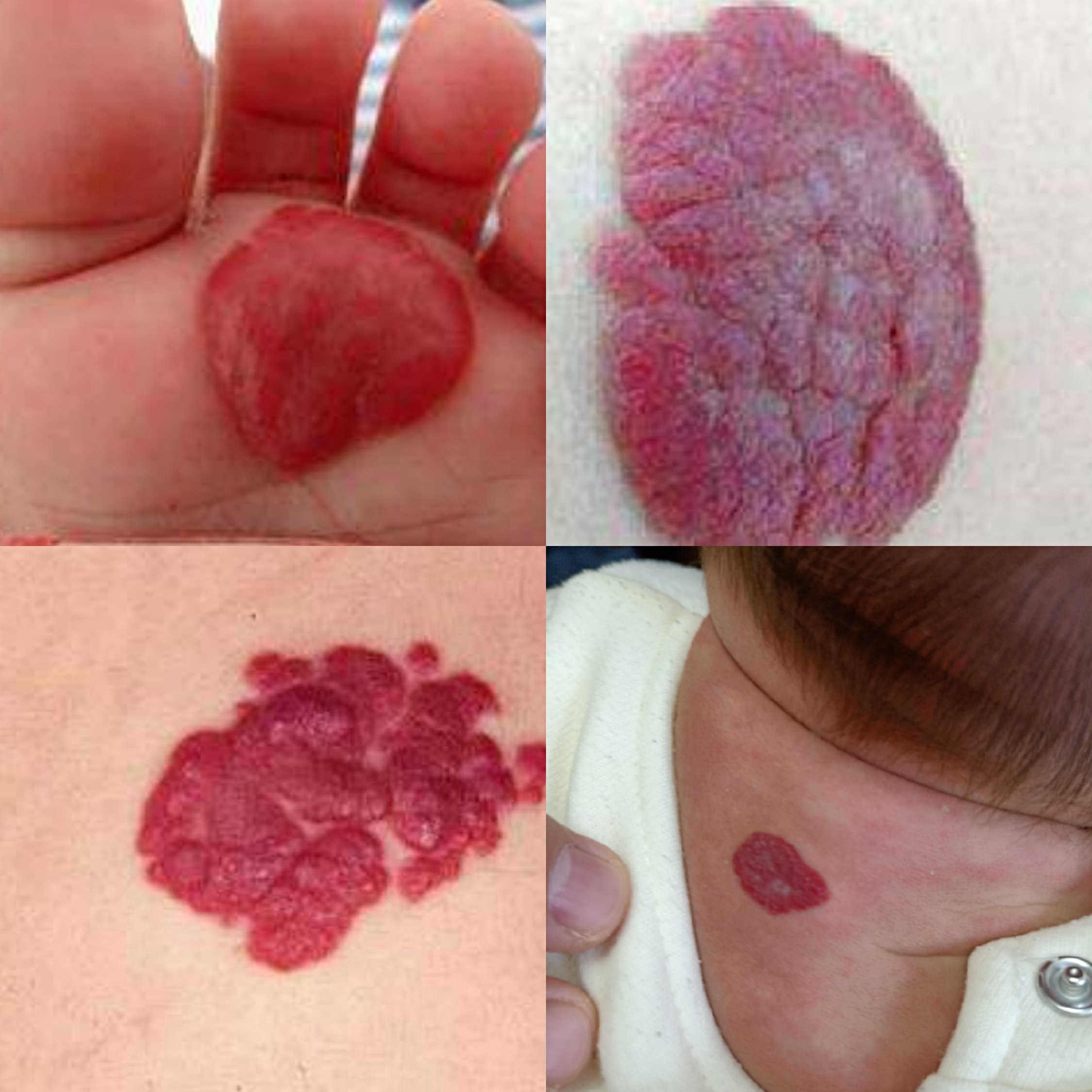 皮肤红色血管瘤图片图片