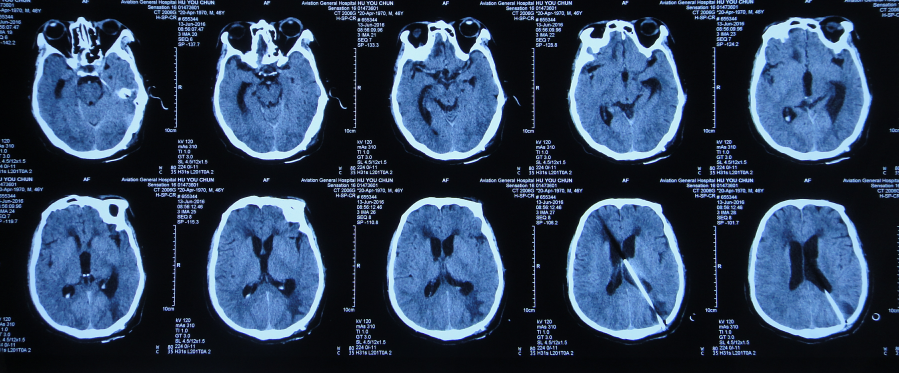 一,李小勇脑脊液中心入院前病史