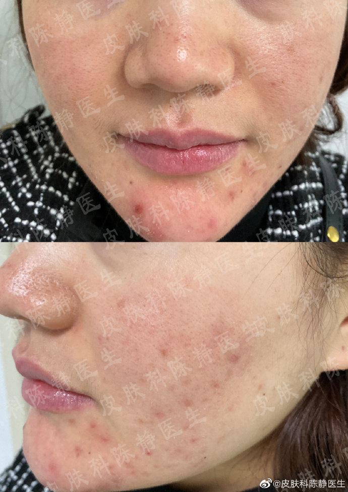 女性雄激素介导的三大皮肤病 痤疮 多毛症和雄激素型脱发 痤疮 痤疮 女性雄激素介导的三大皮肤病 痤疮 多毛症和雄激素型脱发 痤疮 痤疮