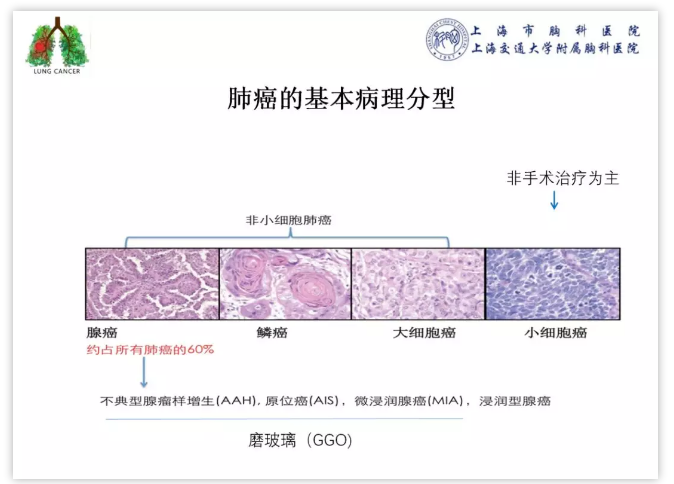 到底什么是肺癌早期 什么是晚期 病理报告怎么解读