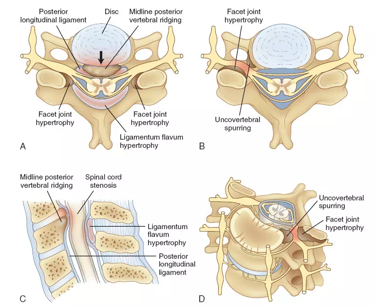显微镜辅助下脊髓型颈椎病的微创治疗方法介绍