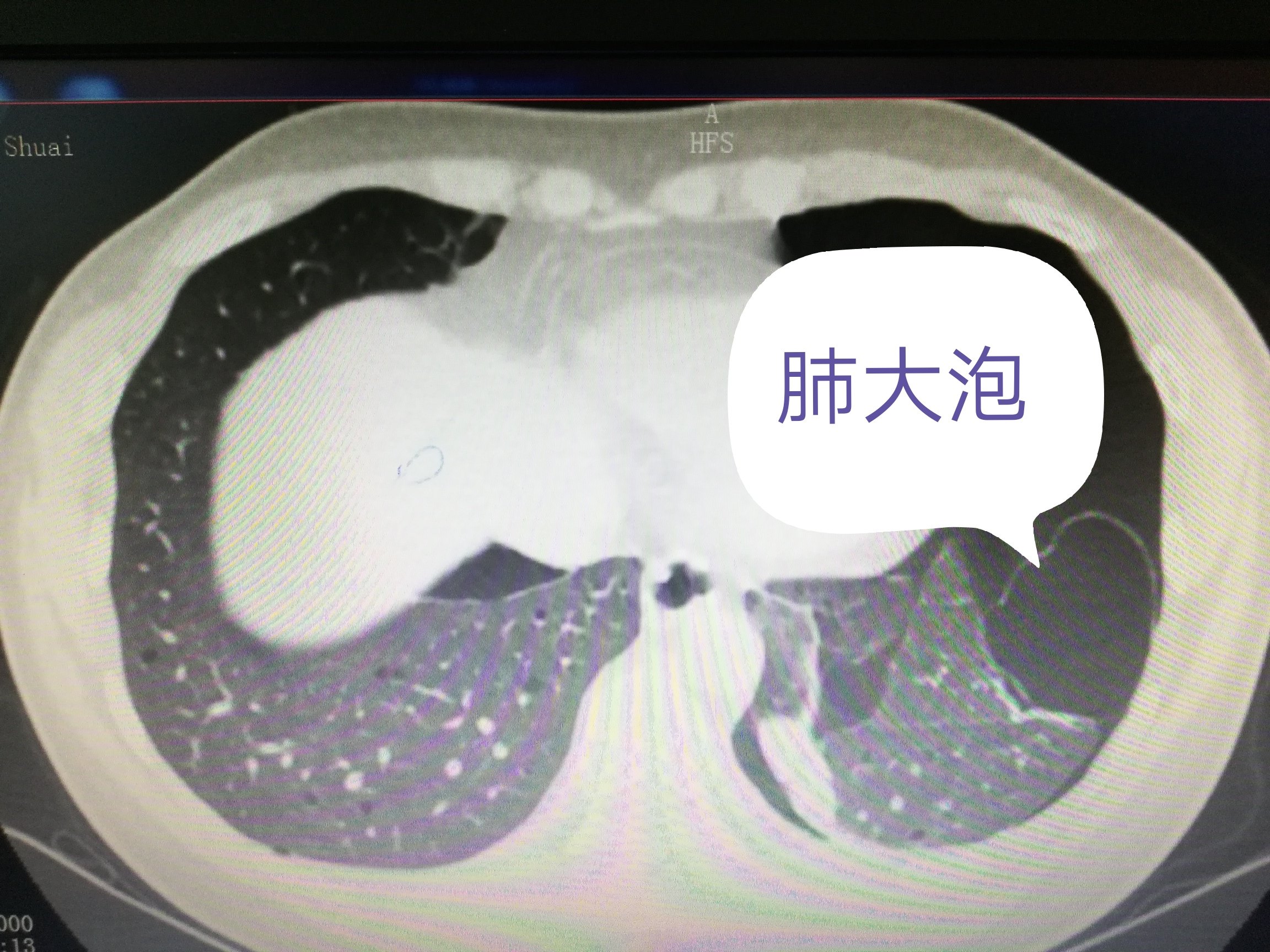 气胸 续篇 除了青年瘦高男性 年轻的女性也会得气胸 气胸 气胸 续篇 除了青年瘦高男性 年轻的女性也会得气胸 气胸