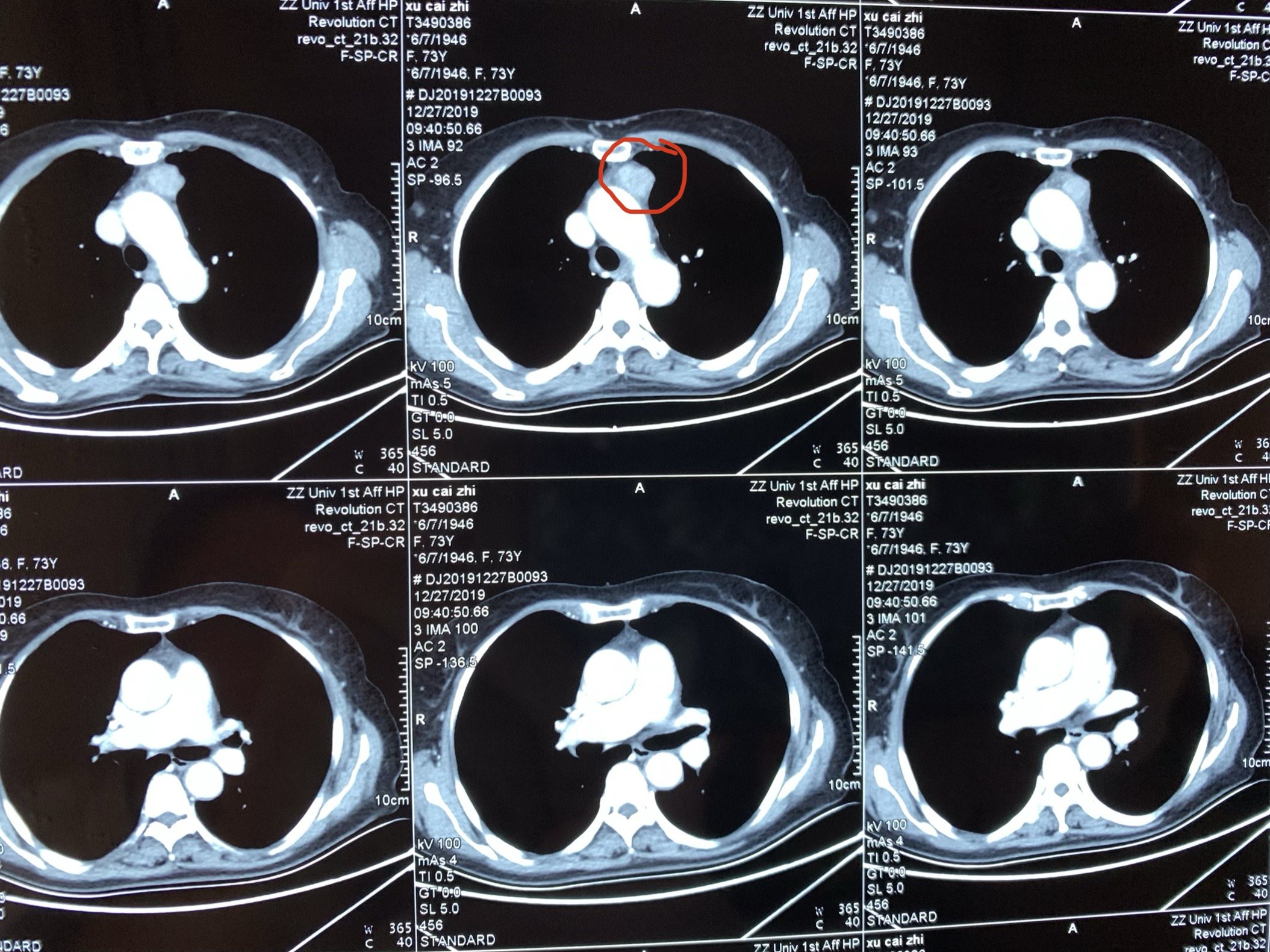 胸腺瘤症状图片