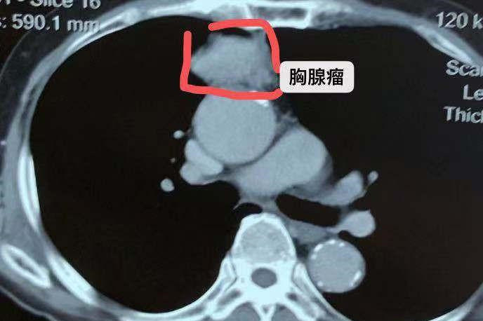 心脏癌的图片图片