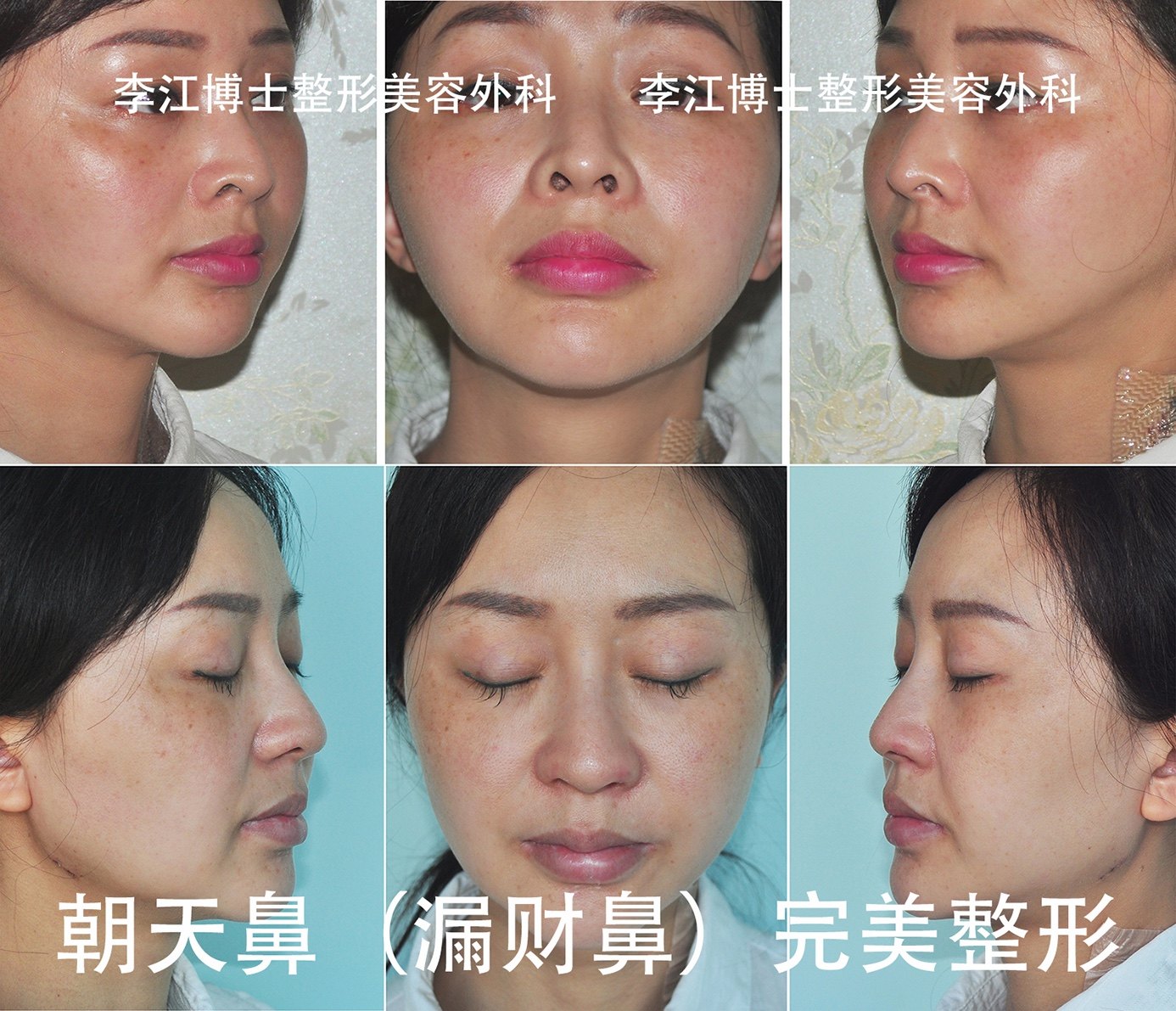 鼻孔外露 朝天鼻 大鼻孔精准整形 多图 鼻部整形 鼻部整形 鼻孔外露 朝天鼻 大鼻孔精准整形 多图 鼻部整形 鼻部整形