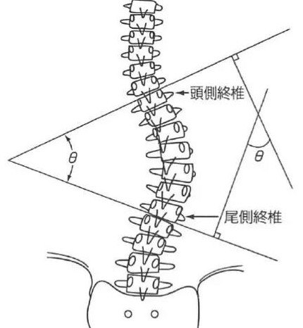 脊柱側彎的診斷標準