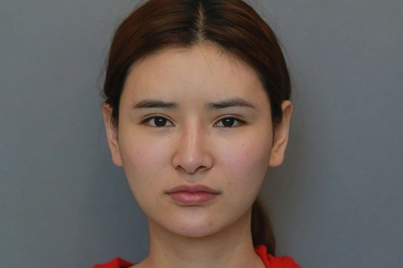 亚洲人隆鼻,鼻背为何优选膨体?_隆鼻_隆鼻治疗介绍 - 好大夫在线