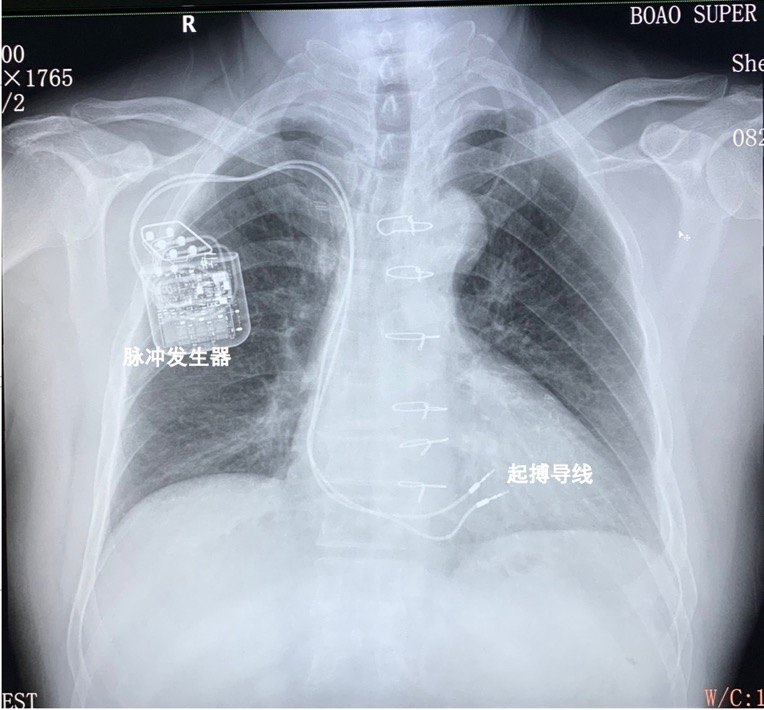 患者術後胸片正側位,顯示脈衝發生器和導線位置圖2.